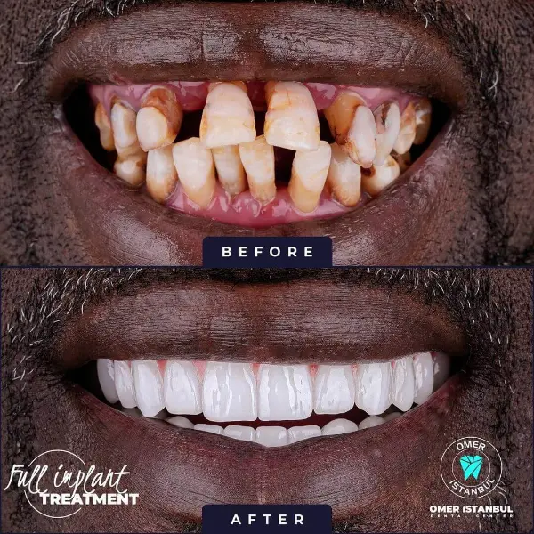 Full dental treatment before after