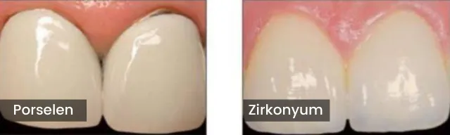 Zirconium porcelain difference