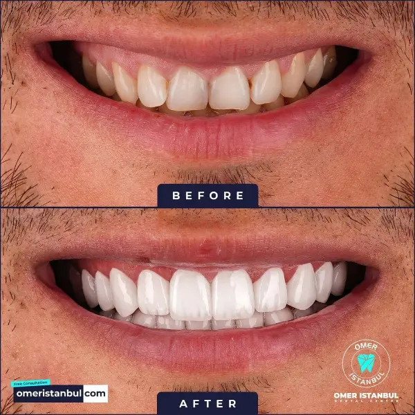 Dental treatment Turkey before after