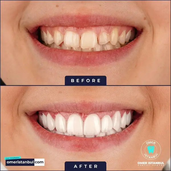 Hollywood smile before after