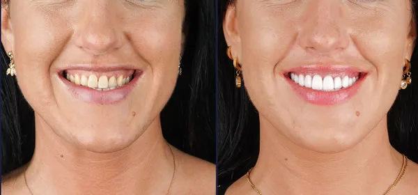 Lip repositioning before after