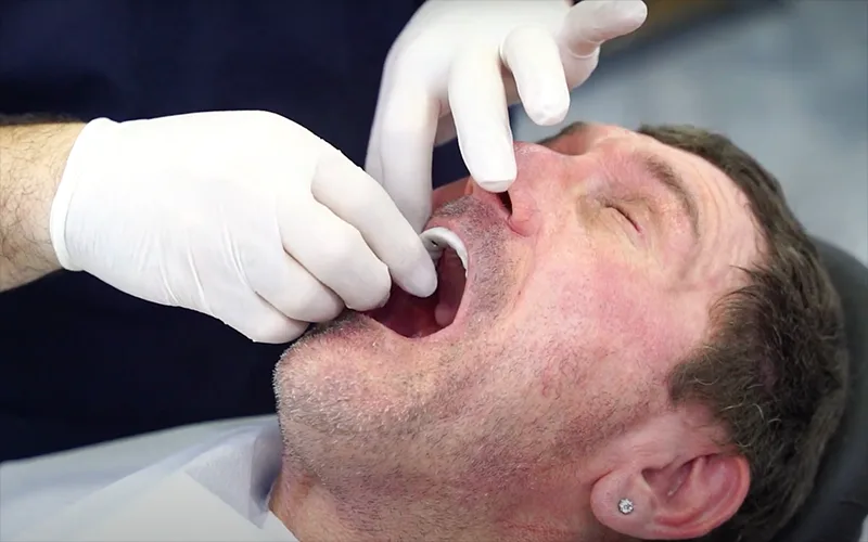 What Should Be Considered After All On Four Implant Treatment?