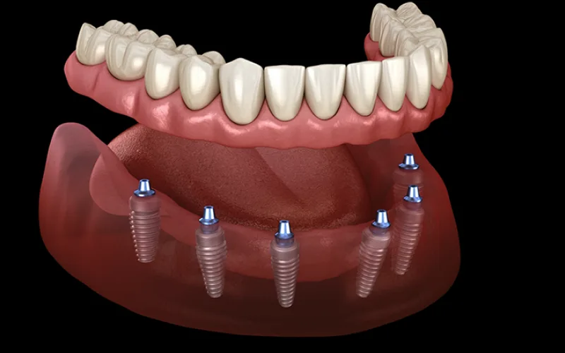 What Is Full-Mouth Implant Treatment?