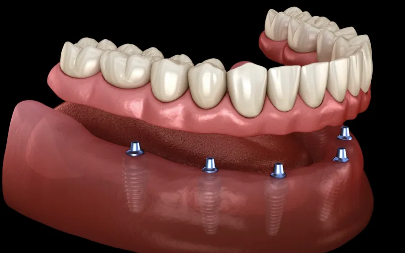 ¿Cuántos Implantes se Necesitan para una Persona sin Dientes?
