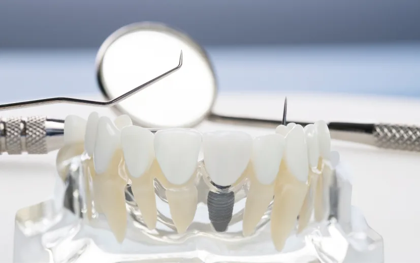 Dental Implant Care And Maintenance: Expert Tips