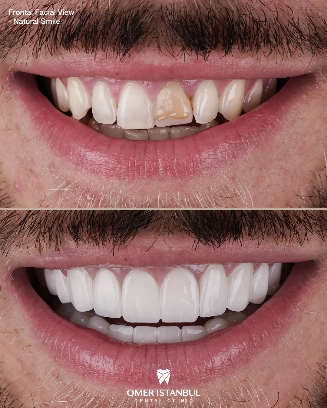 Advanced Aesthetics without Giving Up Zirconia Strength 2