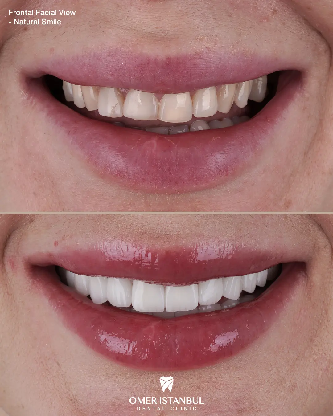 Advanced Aesthetics without Giving Up Zirconia Strength